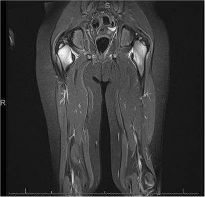 Chronic Non-infectious Osteomyelitis Mimicking Scurvy as the Presenting Sign of Crohn’s Disease: Case Report